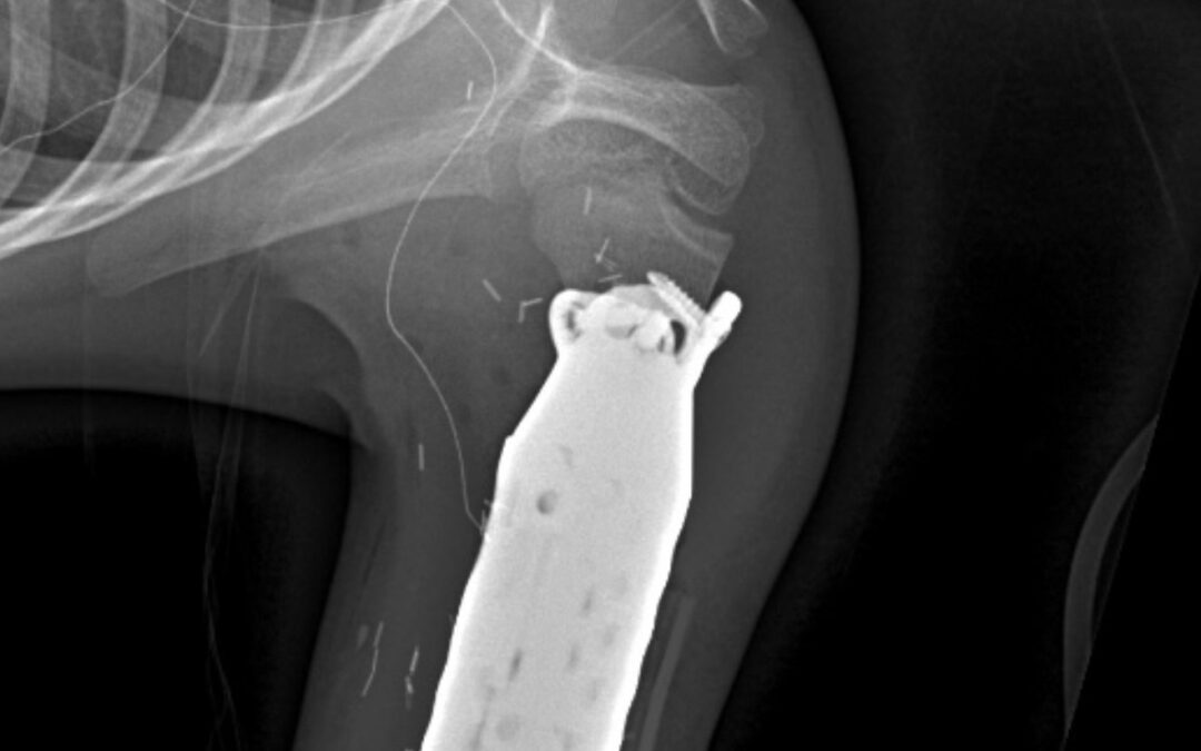 One-of-a-Kind Limb-Sparing Surgery Provides New Hope for a Young Bone Cancer Patient Using 3D Printed Prosthetic